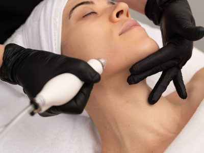 microneedling2